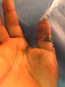 جراحة ميكرو سكوبية ناجحة لإعادة توصيل أصبع مبتور باليد بمستشفيات جامعة المنوفية