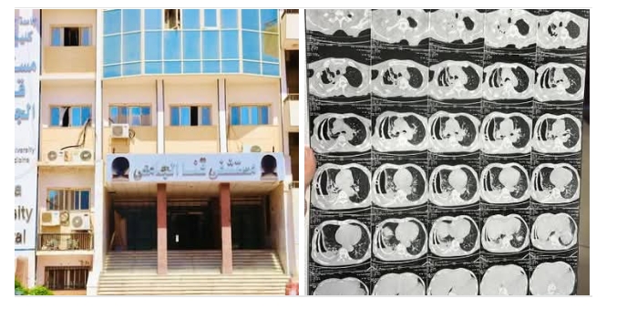 فريق طبي بمستشفىات قنا الجامعية ينجح في العلاج الجراحي والدوائي لمريض الانبعاث القيحي (Calcification encysted Empyema)